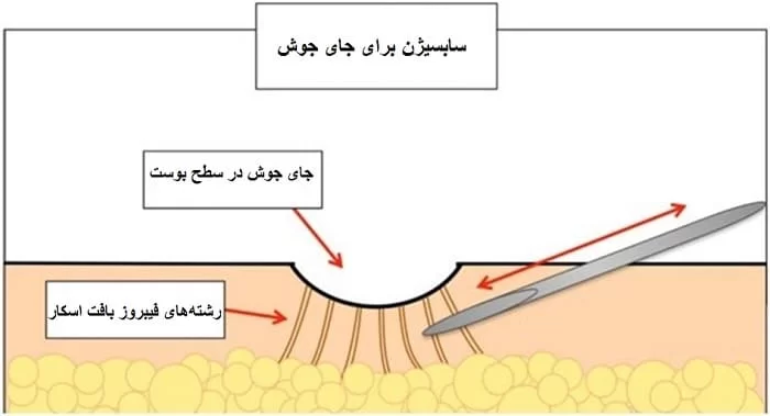 سابسيژن-چیست؟